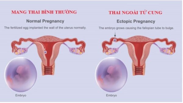 Dấu hiệu sớm của thai ngoài tử cung - Phương Châu Sa Đéc